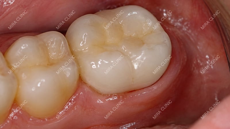 The crown is on a back tooth